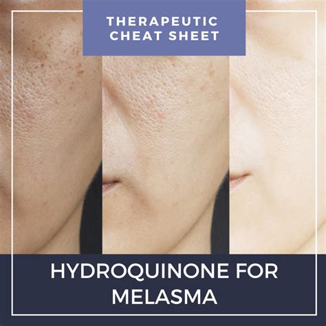 How long should i use hydroquinone