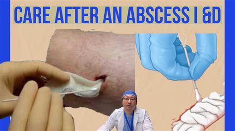 How long should packing stay in abscess