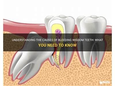 How long should wisdom teeth bleed