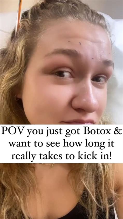 How long until botox kicks in