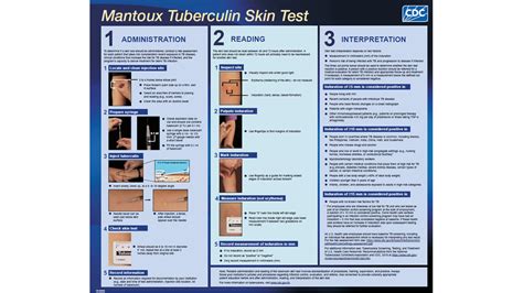 How mantoux test is done