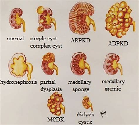 How many cysts on kidneys are normal? – Sage-Answer