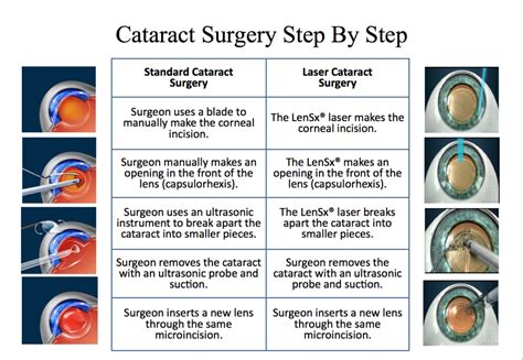 How many hours does cataract surgery take