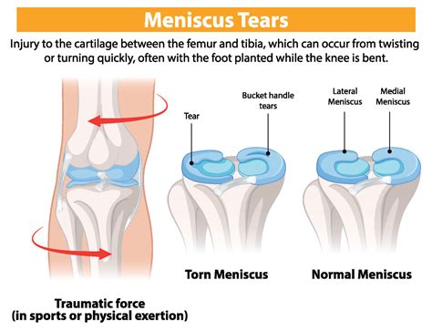 How meniscus is torn