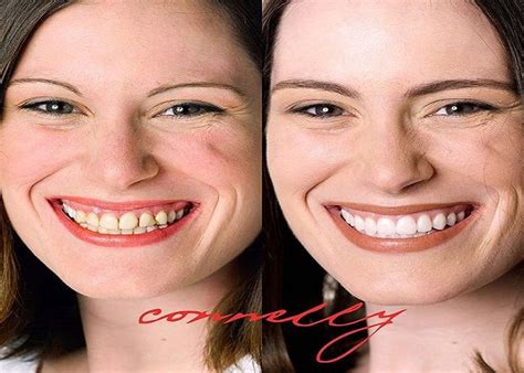 How much does delta dental cover for veneers. Updated: 08/07/2023 Porcelain veneer costs may be a concern if you're on a budget, but there's more to consider when it comes to this cosmetic treatment. The price tag is higher than other veneer choices, but you get … 