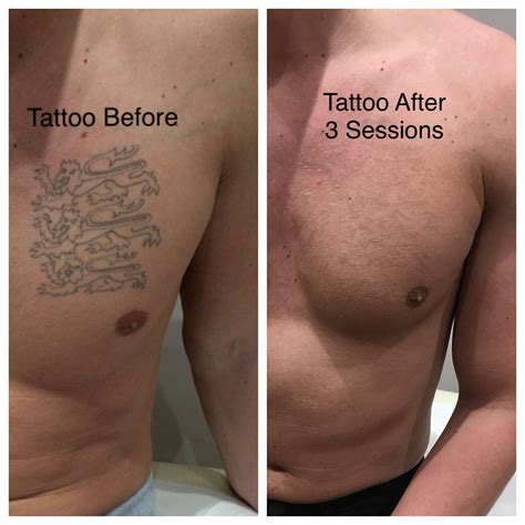 How much does it cost to remove a tattoo. Cost Range: $50-$500 per treatment. Tattoo removal creams contain various chemicals designed to break down tattoo pigments. These creams are applied directly to the tattooed area and work gradually over an extended period. However, their efficacy is often debated and results can vary. 