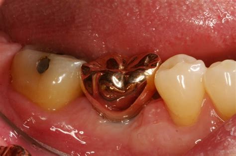 How much gold is in a dental crown? - Gold Center