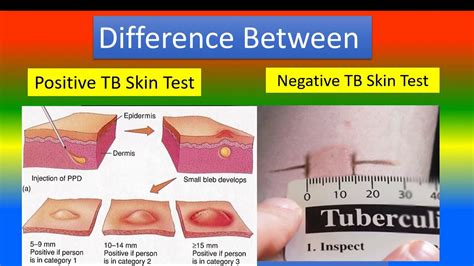A PPD test is a screening method for checking if a person has active or latent tuberculosis. People who have had unknown exposure to TB in the past may get a …