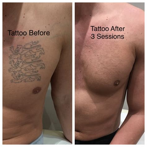 How much is a tattoo removal. How Much Does Laser Tattoo Removal Cost? Laser tattoo removal cost is not uniformly calculated, and the best way to breakdown cost of laser tattoo removal is the cost by treatment or session. Across the United States, laser tattoo removal cost can range between $200 to $500 per removal treatment, which usually varies based on factors like ... 