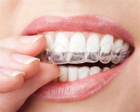 How much is invisalign without insurance. Aug 23, 2021 · Your monthly payments will be: ($5,000 – $500)/24 = $187.50 each month. If you have insurance that covers a percentage of your treatment, your monthly cost will be even less expensive. Receiving a straighter smile with Invisalign can be a valuable investment, but it shouldn’t be a substantial financial burden. 