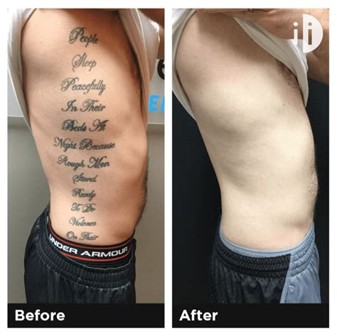 How much is it to remove a tattoo. What to Expect: Everyone’s Tattoo Removal Progress is Unique . Good things come to those who wait. While the number of sessions required to remove a tattoo varies based on many factors, most pieces take about 10-12 visits before you see full removal. These treatments must be six to eight weeks apart to give your skin time to heal. 