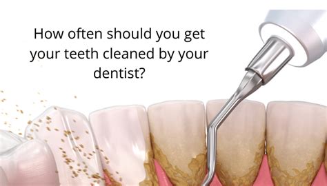 How often should teeth be cleaned