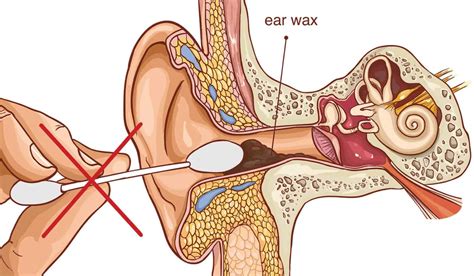 How often should you get earwax removed