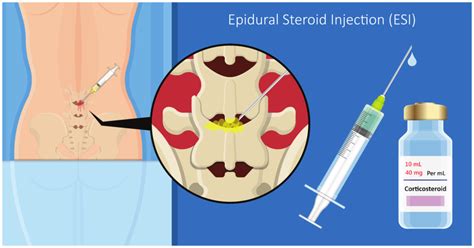 How often should you get epidural injections