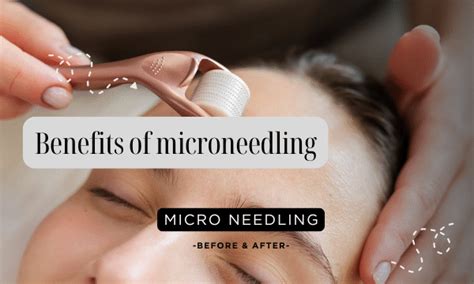 How often should you use microneedling