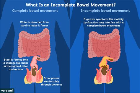 How often should your bowels open