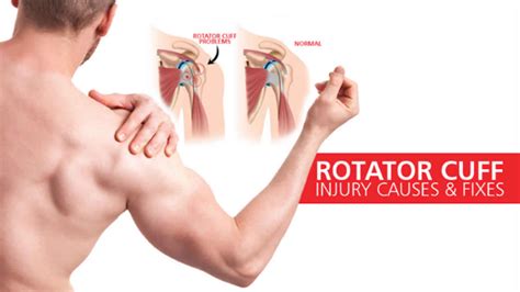 How painful is a rotator cuff injury