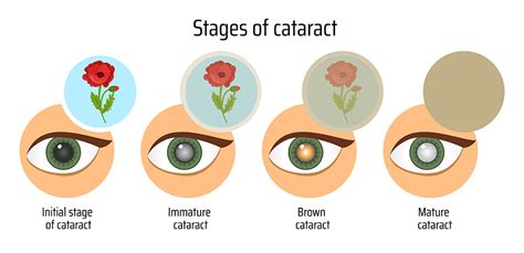 How quickly can cataracts cause blindness
