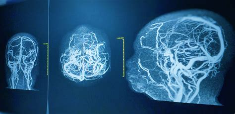 How safe is an angiogram