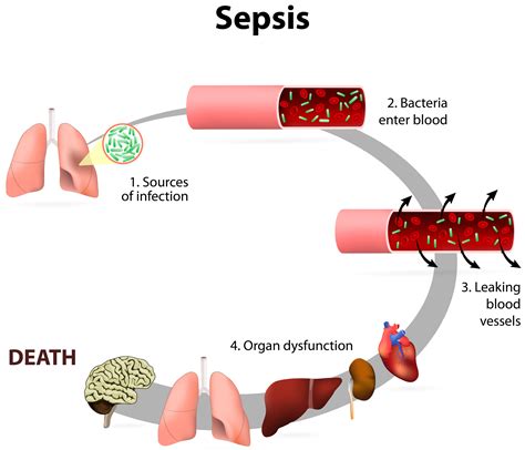 How sepsis is caused