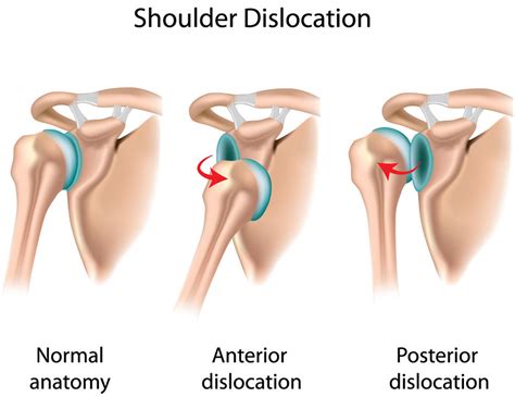 How serious is a dislocated shoulder