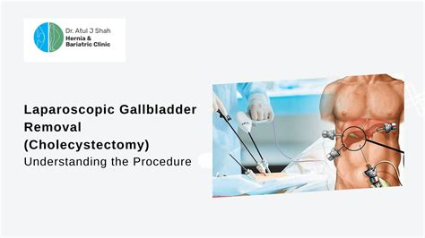 How serious is a gallbladder removal