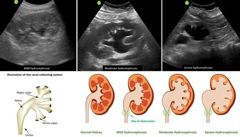 How serious is hydronephrosis