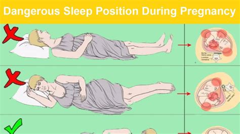 How should i lay during pregnancy