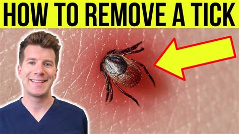 How should you remove a tick