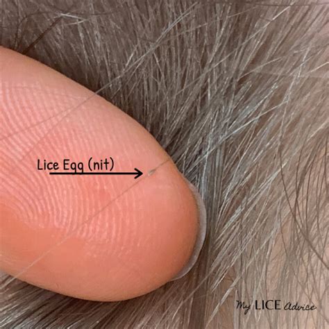 How to Check for Lice Eggs or Nits