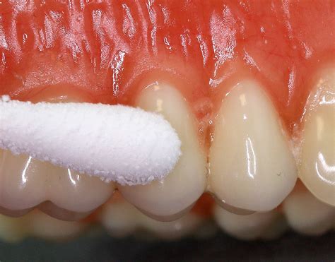 How to Conduct an Endo Ice Test for Irreversible Tooth Pulpitis