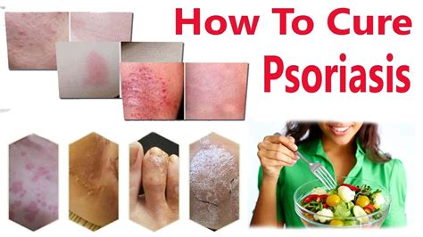 How to Cure Psoriasis Naturally - YouTube