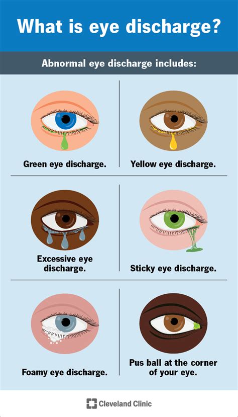 How to Deal With Eye Discharge