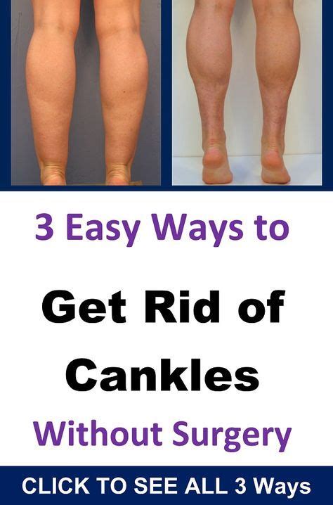 How to Get Rid of Cankles