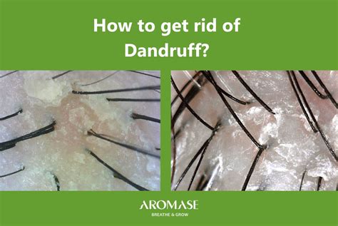 How to Get Rid of Dandruff - Insider