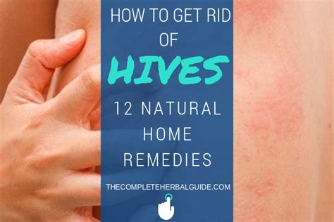 How to Get Rid of Hives: 15 Ways