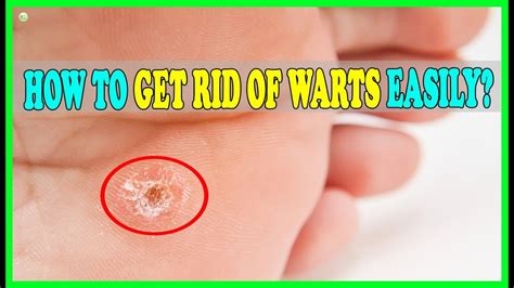 How to Get Rid of Plantar Wart Naturally: 12 Best At-Home Rem…