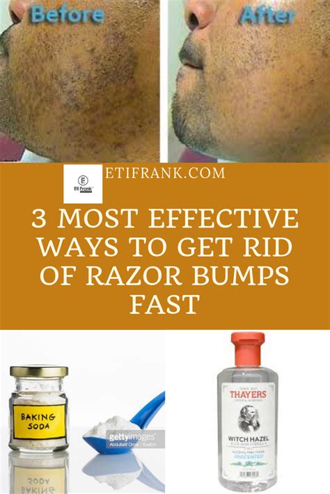 How to Get Rid of Razor Bumps On Black Men: Effective Treatment