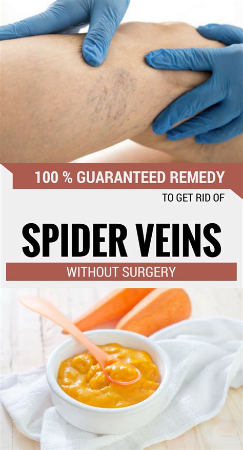 How to Get Rid of Spider Veins and Varicose Veins SELF