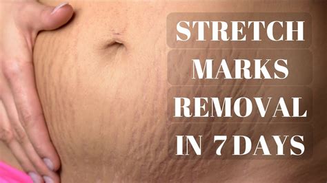 How to Get Rid of Stretch Marks on Your Bum Quickly!