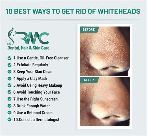 How to Get Rid of Whiteheads on Men