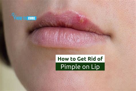 How to Get Rid of a Painful Lip Pimple-Lip Pimple Treatment - Men