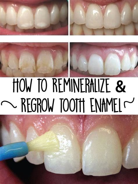 How to Help Build Enamel On Your Teeth