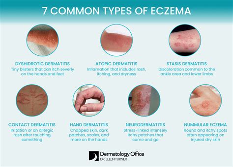 How to Identify and Treat Eczema