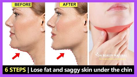 How to Make the Skin Under the Chin Tight After Chin Liposuction?