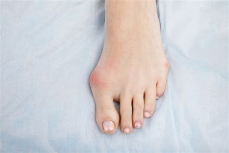 How to Prevent Bunions from Developing and Getting Worse Custom