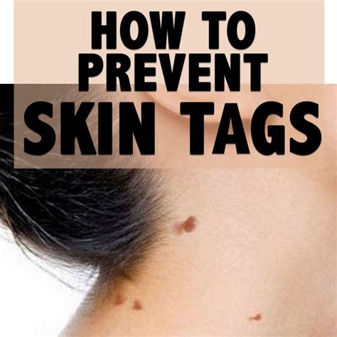 How to Prevent Skin Tags And How to Get rid of Them