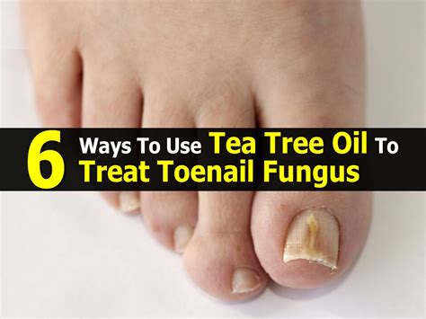 How to Prevent Toenail Fungus with Tea Tree Oil-- - YouTube