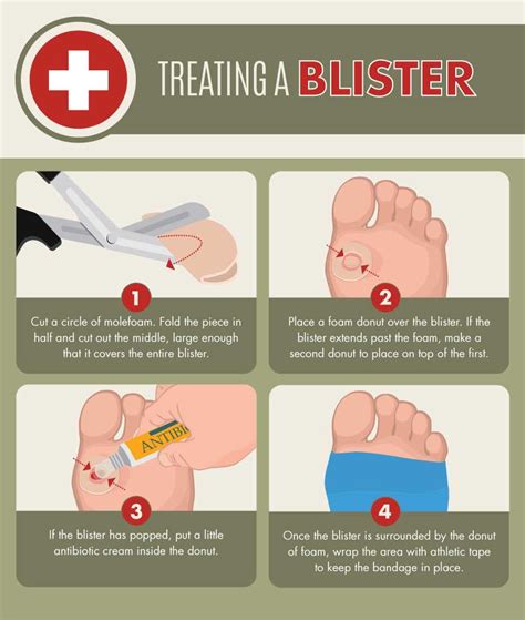 How to Prevent and Treat Blisters