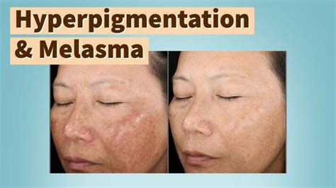 How to Prevent and Treat Melasma and Hyperpigmentation